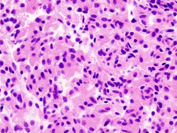 File:Pituitary adenoma (2) GH production.jpg