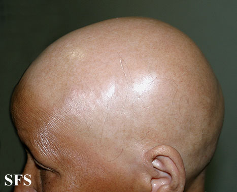 File:Alopecia areata 26.jpeg