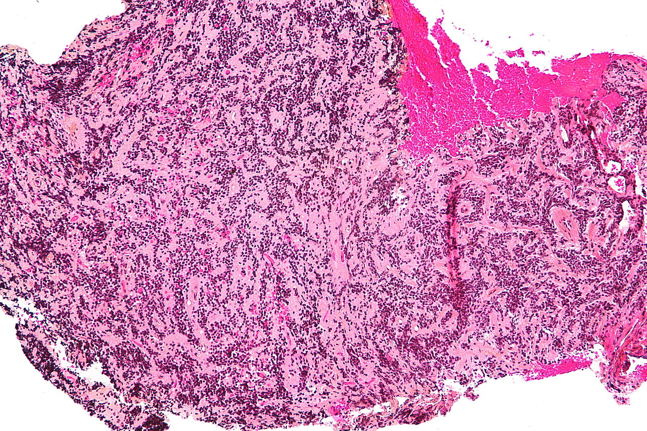 Intermediate magnification micrograph of a pineocytoma. HPS stain.[10]