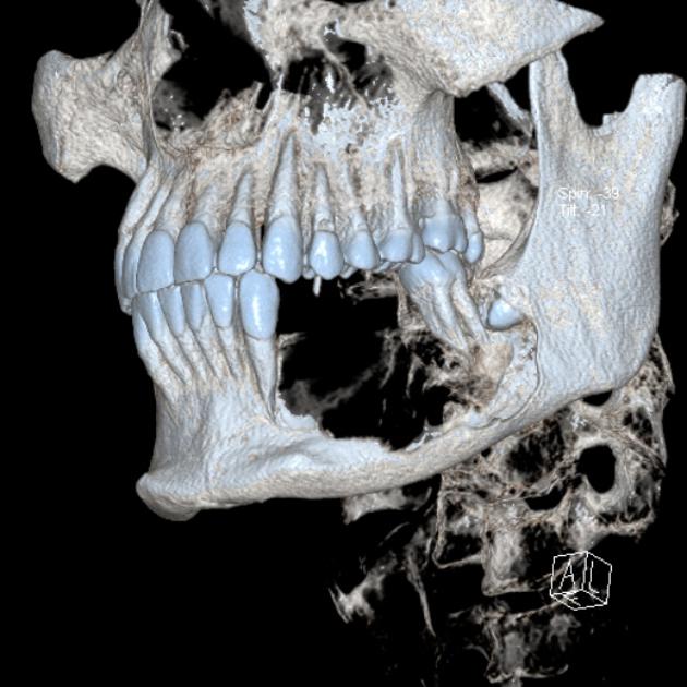 3D ameloblastoma[2]