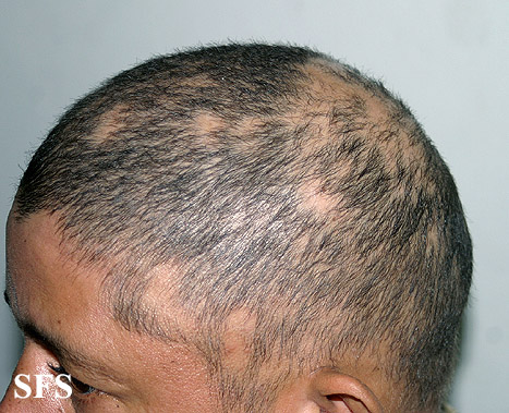 File:Alopecia areata 22.jpeg