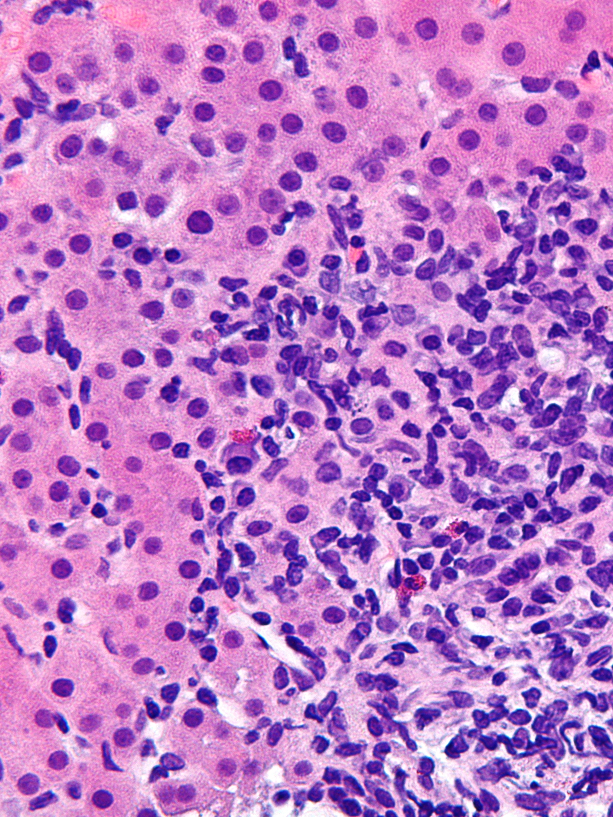 File:Autoimmune hepatitis - cropped - very high mag.jpg