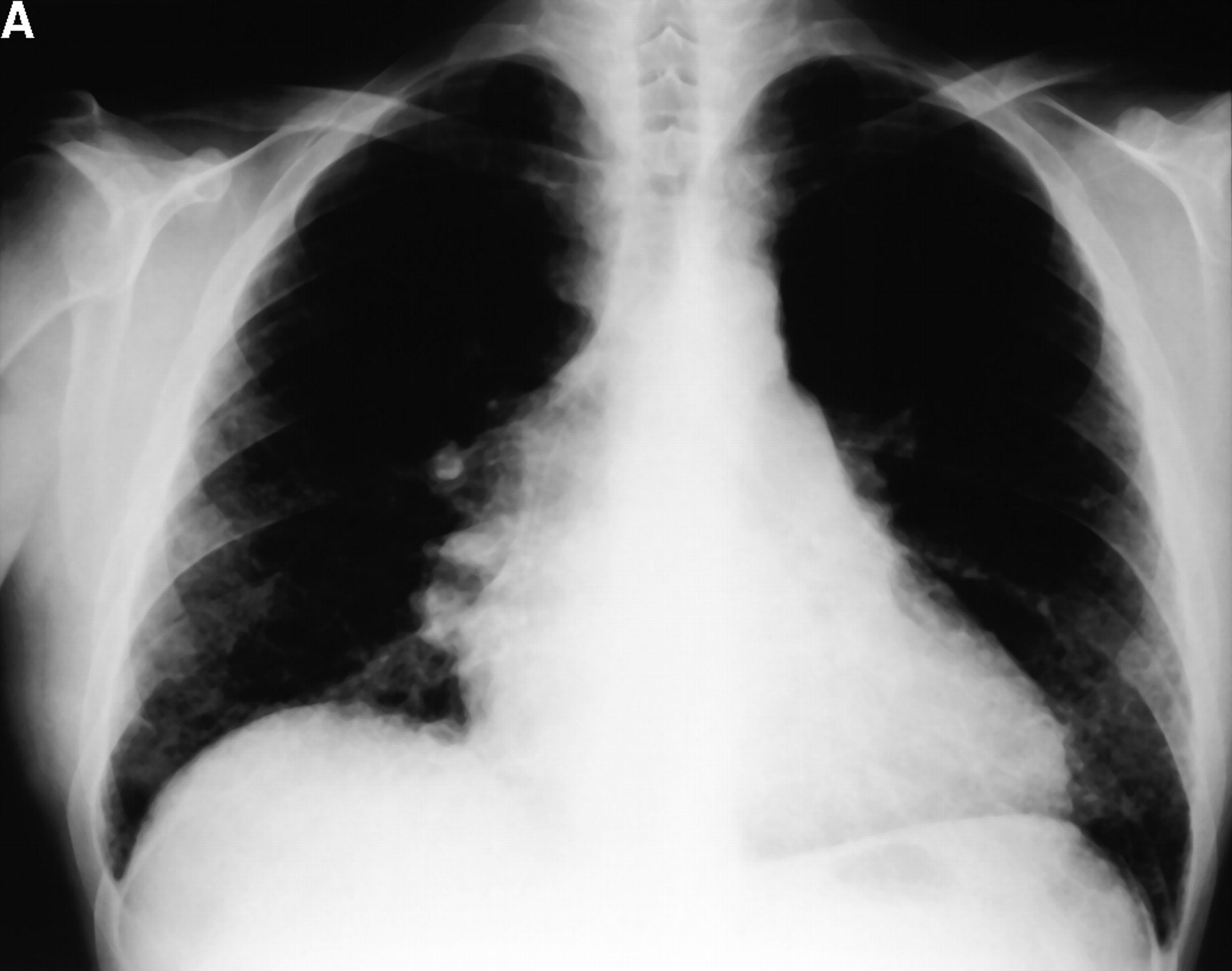 Chest x-ray for a patient with advanced Histiocytosis X associated with severe pulmonary hypertension