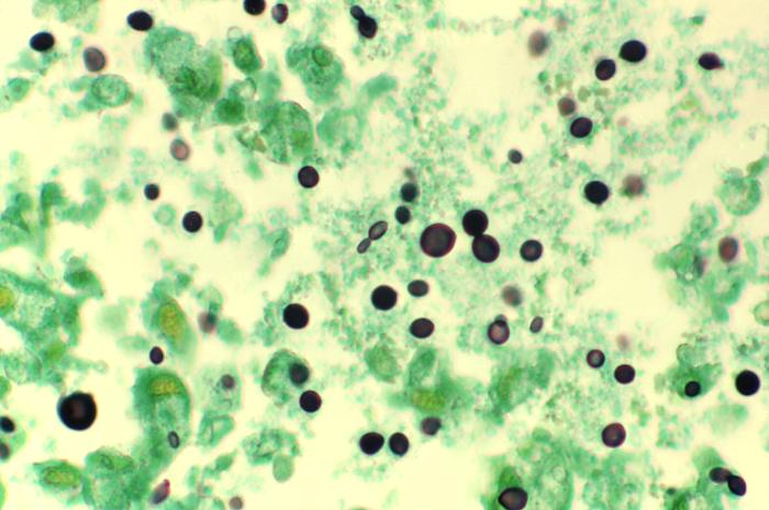Cryptococcosis of lung in patient with AIDS. Methenamine silver stain. From Public Health Image Library (PHIL). [7]