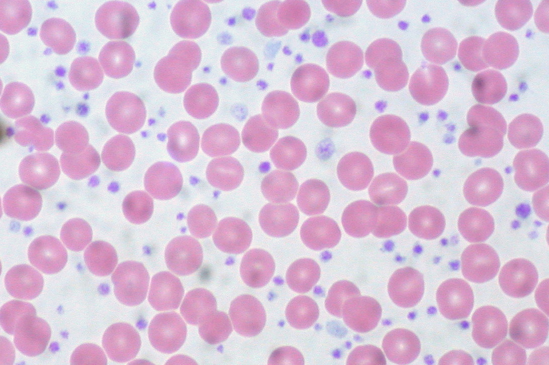 This represents a platelet count between 1.5 and 2 million per microliter (normal range is between 0.150 and 0.450 million). The patient had had an elevated count for at least 15 years but is asymptomatic.[11]