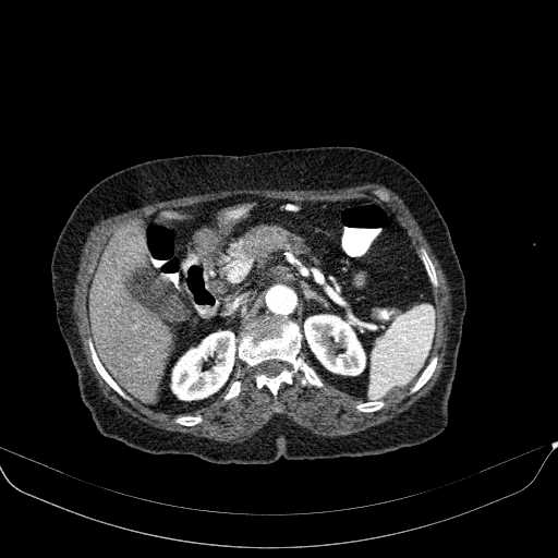 File:Pancreatic-ductal-carcinoma (1).jpg