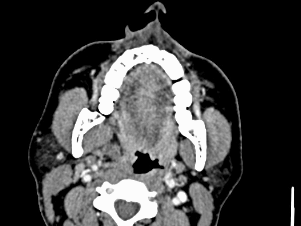 File:Pleomorphic adenoma CT.gif