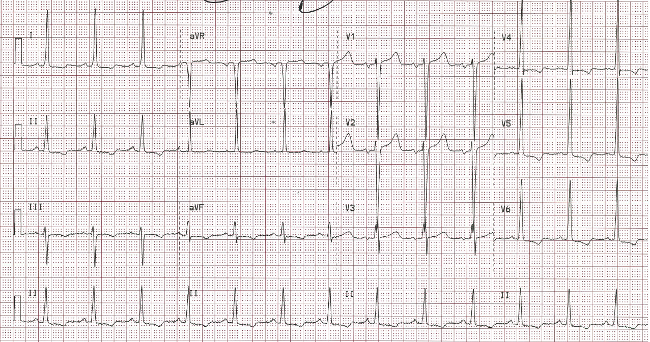 File:Q wave absent in anterior distribution.PNG