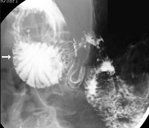 Upper gastrointestinal series showing duodenal dilation (white arrow).
