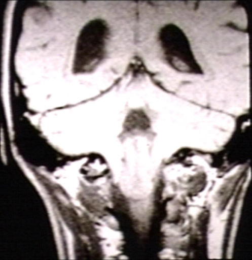 BRAIN: ARNOLD CHIARI MALFORMATION; 2/3 T2 (MRI)