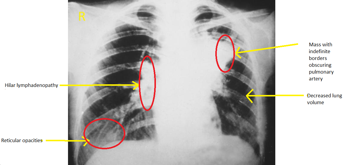 This AP chest X-ray demonstrates lung infiltrates due to Blastomycosis, caused by Blastomyces dermatitidis