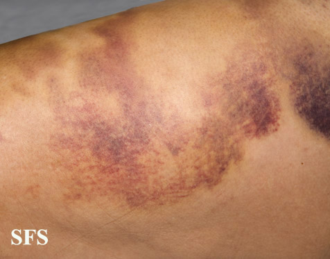 File:Painful bruising syndrome08.jpg