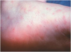 Early stage rash in a patient with RMSF