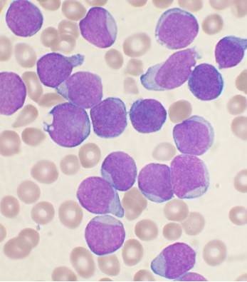 A Wright's stained bone marrow aspirate smear from a patient with leukemia.