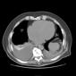 File:Axial CT aspiration 3.jpg