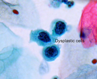 Dysplastic cells.jpg