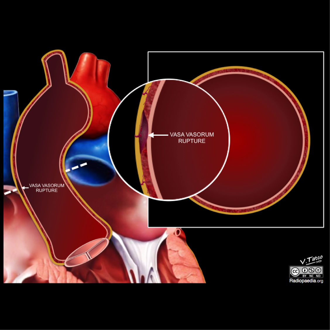 File:Pathogenesis-of-aortic-intramural-haematoma-illustration.png