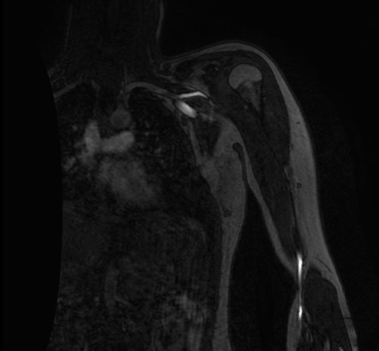 File:Thoracic outlet syndrome MRI 001.jpg