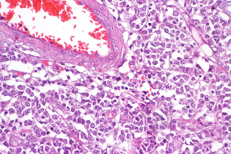 File:Diffuse large B-cell lymphoma of the small intestine (high mag).jpg