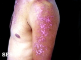 Lupus Erythematosus Chronicus Disseminatus Superficialis. Adapted from Dermatology Atlas.[15]
