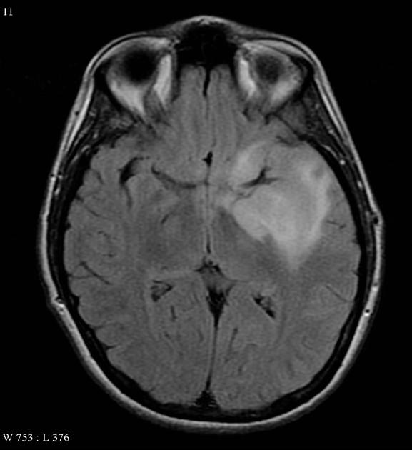 RI axial FLAIR showing a relatively well circumscribed mass involving the temporal lobe and insular cortex, without convincing enhancement, and minimal restricted diffusion.[1]