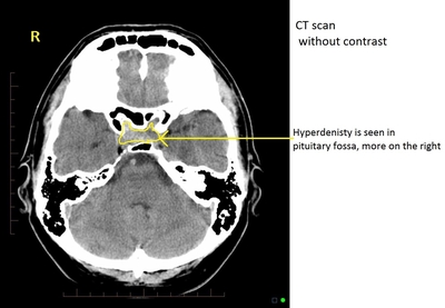 CT without contrast showing intrasellar mass.(Source: Case courtesy of A.Prof Frank Gaillard, Radiopaedia.org, rID: 2735)
