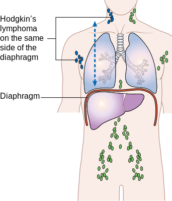 File:Stage 2 Hodgkin's lymphoma.png