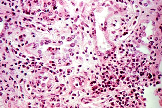 This is a higher-power photomicrograph of kidney from the previous image demonstrating the cellular infiltrate which is comprised of lymphocytes, macrophages, plasma cells and a few neutrophils.