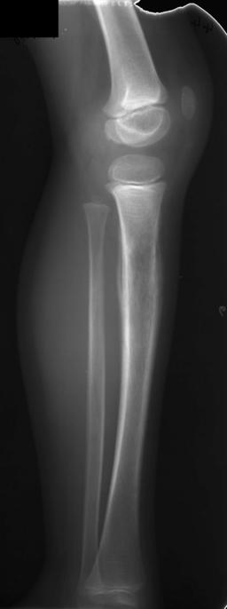 X-Ray of a child with Ewing's sarcoma of the tibia.[1]