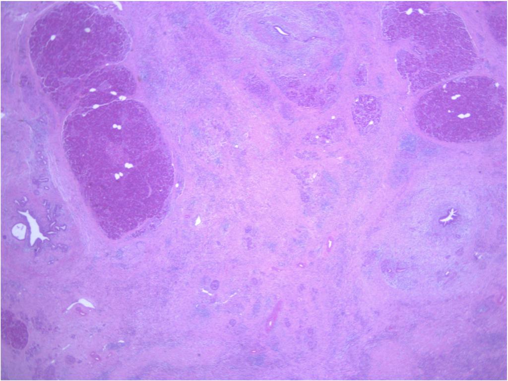 File:Mass-forming-autoimmune-pancreatitis (3).jpg