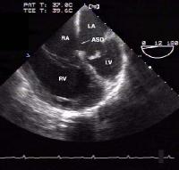 Defect is present in the lower portion of the inter-atrial septum.