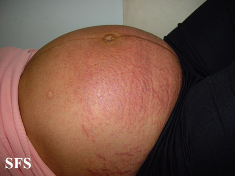 File:Pruritic urticarial papules and plaques of pregnancy02.jpg