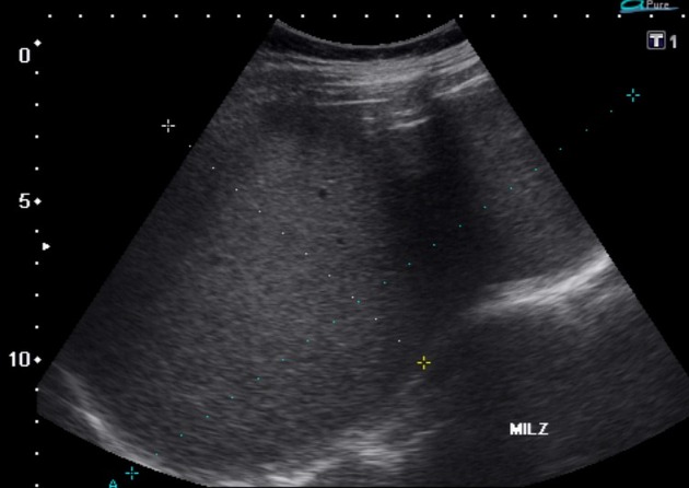 Longitudinal view: Splenic diameter about 20 cm in the long axis. Subhepatic enlarged lymph nodes.[2]