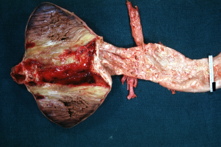 Abdominal Aneurysm: Gross, natural color, opened aneurysm with well shown and typical laminated thrombus (external view)