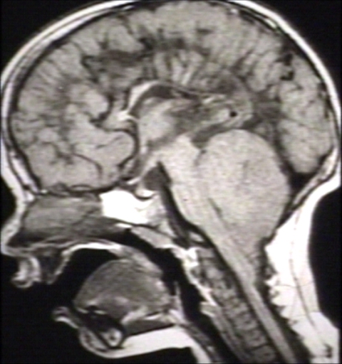 BRAIN: ARNOLD CHIARI II WITH HYPOPLASTIC CORPUS CALLOSUM AND STENOGYRIA; T1 (MRI)