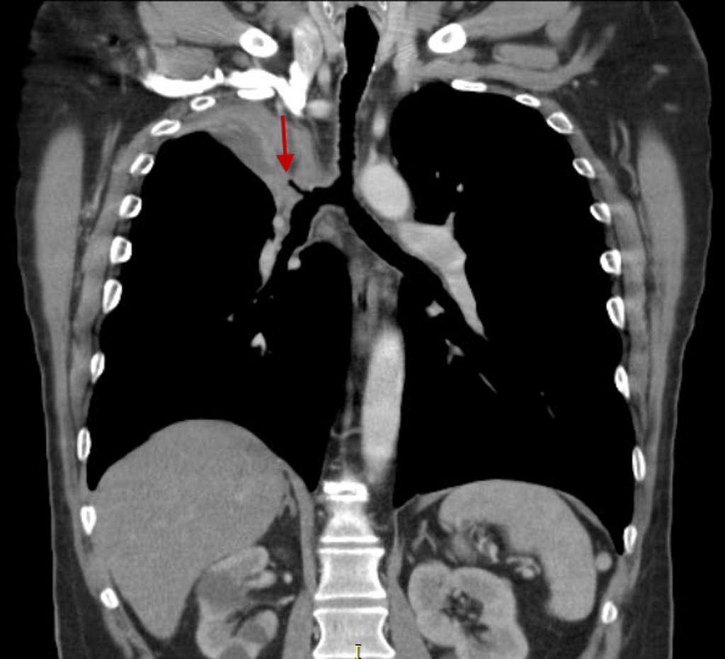 Bronchogenic lung carcincoma: upper lobe collapse via, radiopedia.org Case courtesy of Dr Ahmed Abdrabou, [4]
