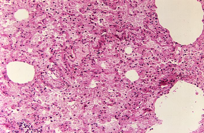 Hematoxylin-eosin stained lung tissue sample revealed the histopathologic changes indicative of what was diagnosed as a case of fatal human plague from the country of Nepal (125x mag). From Public Health Image Library (PHIL). [18]