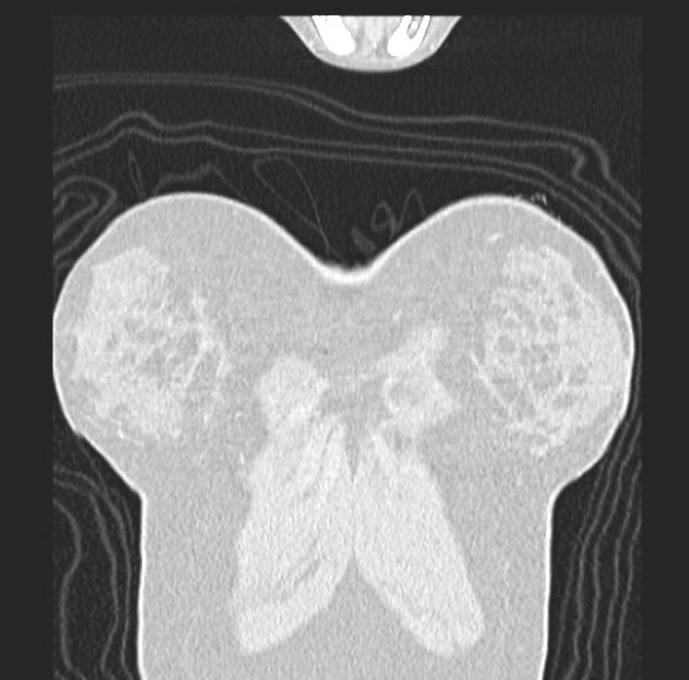 File:Miliary metastasis from papillary thyroid cancer CT.jpeg