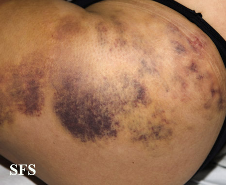 File:Painful bruising syndrome11.jpg