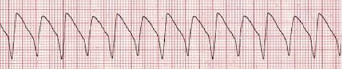 File:Pulseless ventricular tachycardia.jpg