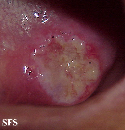 url = http://www.atlasdermatologico.com.br/disease.jsf?diseaseId=430>
