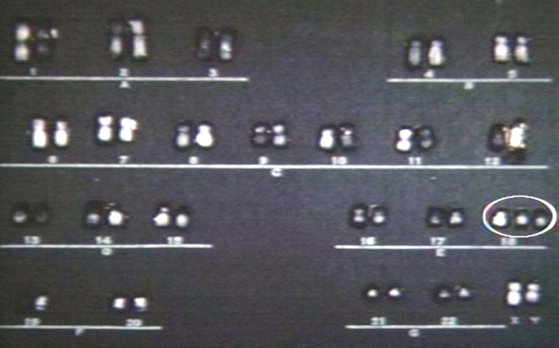 Trisomy 18 karyotype.jpg