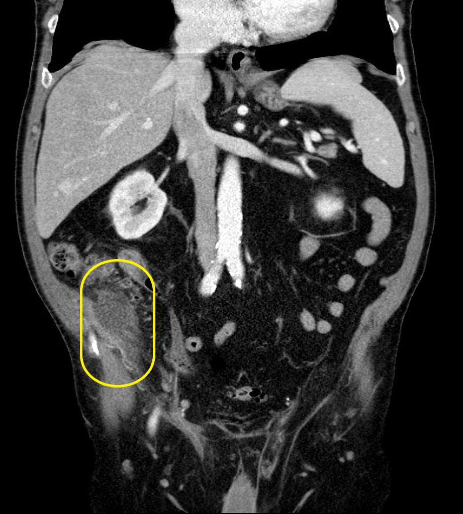File:Appendiceal-adenocarcinoma-complicated-by-retroperitoneal-abscess.jpg