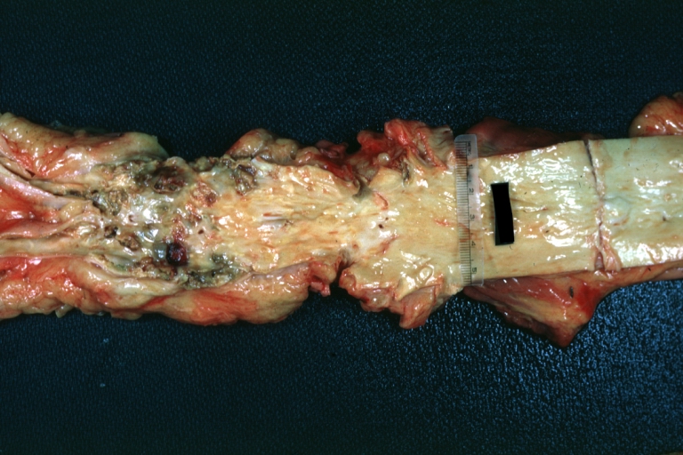 Aorta, Atherosclerosis: Gross natural color view of descending thoracic and abdominal segments with expected distribution of atherosclerotic lesions in subject over 60 years old. Not much in thoracic segment and extensive plaques in abdominal segment, some with ulceration