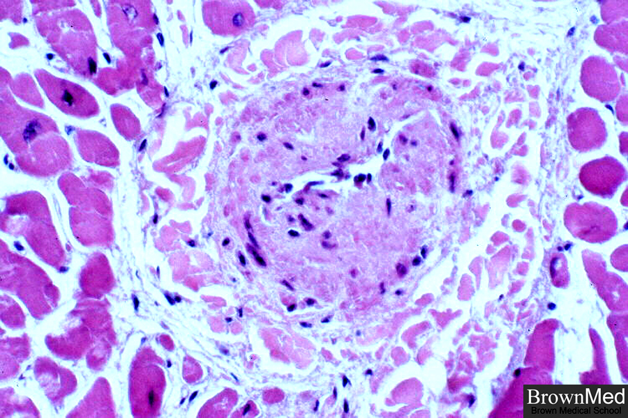 File:Fibromuscular dysplasia microscopic pathology.jpg