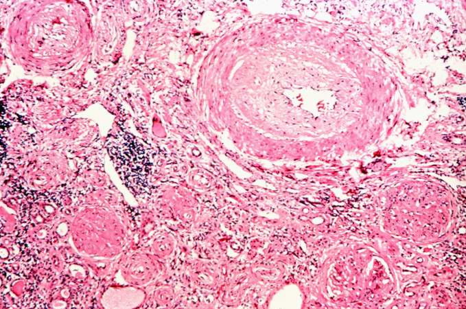 This is a photomicrograph of interstitial and vascular lesions in end stage renal disease.
