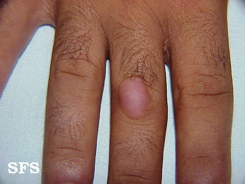 Knuckle Pads. Adapted from Dermatology Atlas.[3]