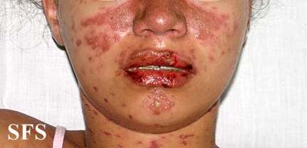 Lupus erythematosus-systemic. Adapted from Dermatology Atlas.[26]
