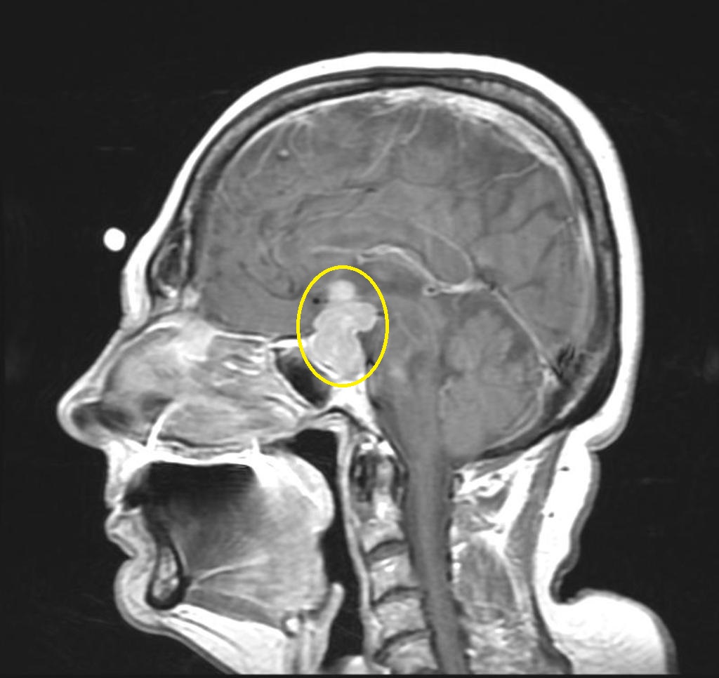 Pituitary adenoma - Case courtesy of A.Prof Frank Gaillard, Via Radiopaedia.org[9]