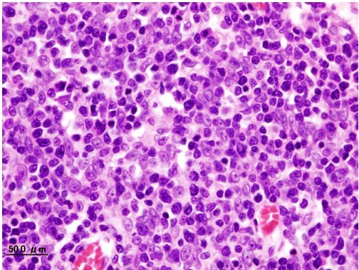 Histopathological image representing a noninvasive Thymoma type B1, surgically resected. Hematoxylin & eosin